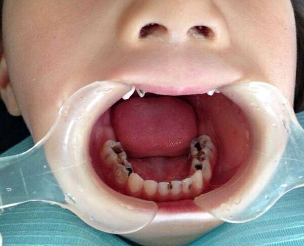 六龄牙位置图片 蛀牙图片