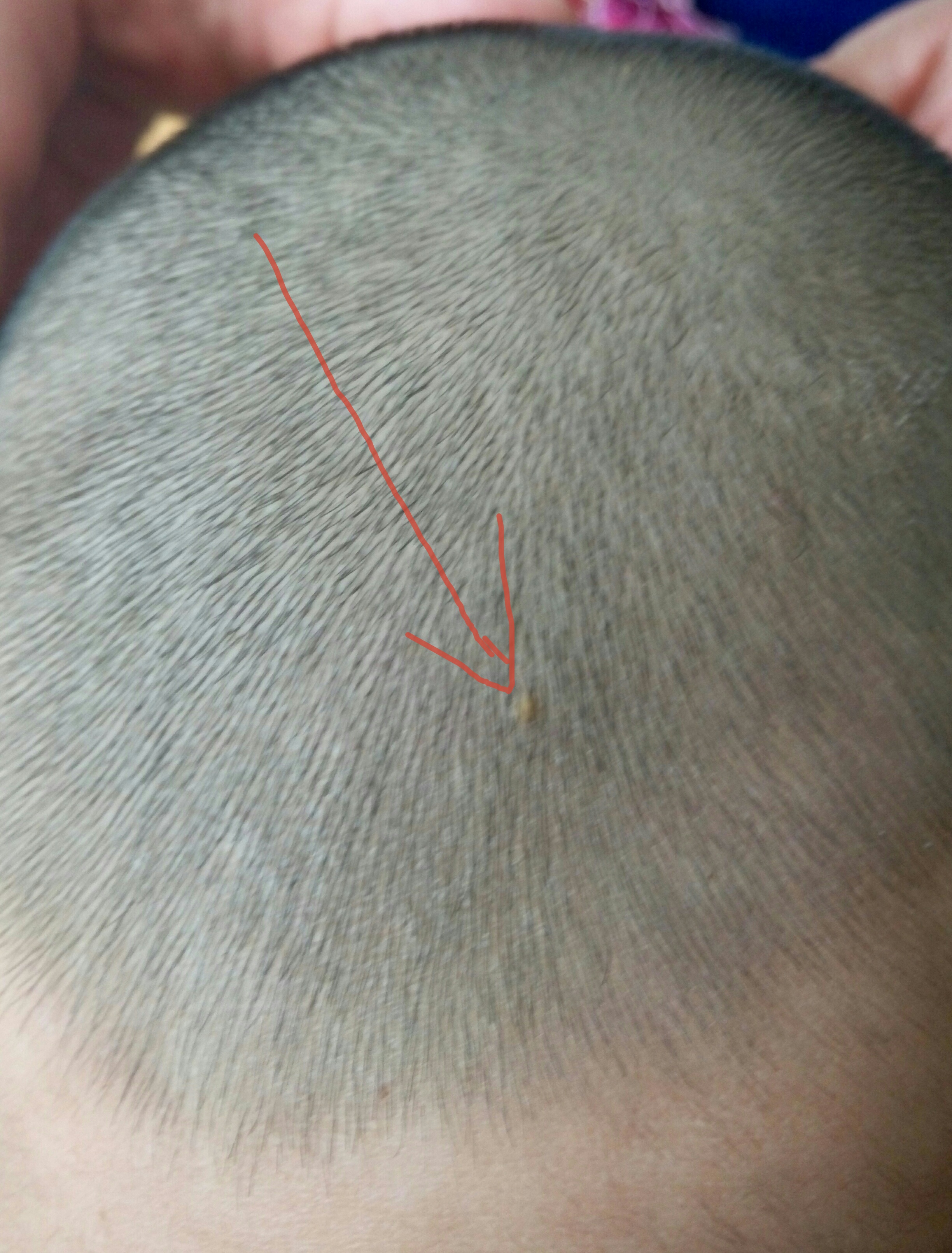 幼年黄色肉芽肿是怎么回事