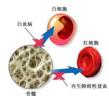 劉風教授談再生障礙性貧血——規範再障治療,贏得生命未來