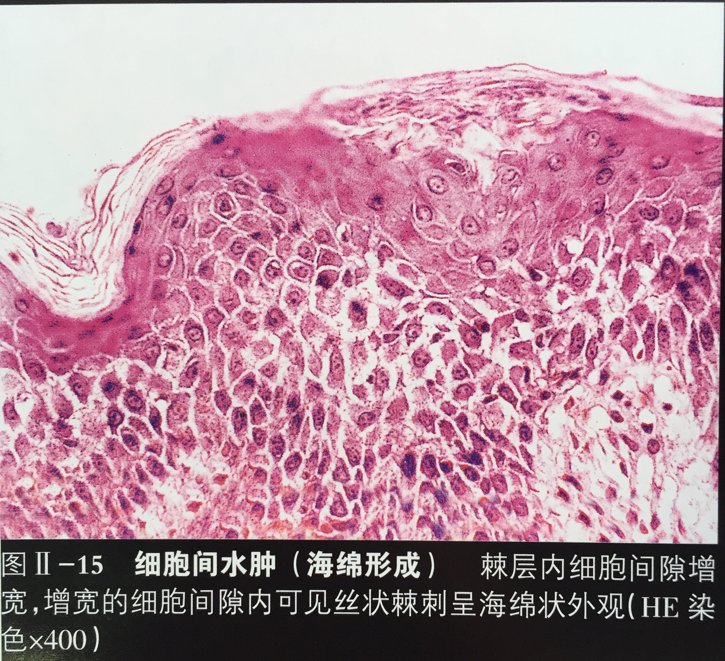 现泛指一组具有发红,瘙痒明显的炎症性皮肤病,常伴鳞屑,且病理学上
