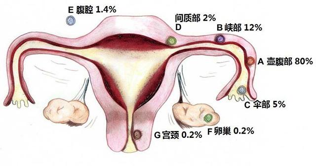 宫外孕图片示意图腹部图片