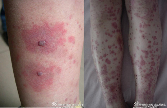 过敏性紫癜不容小觑