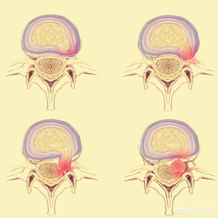 聽說腰疼和腿疼,都有可能是腰椎間盤突出引起的,是真的嗎?