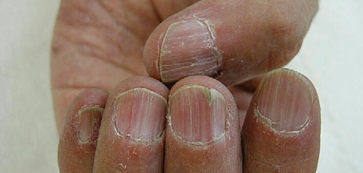 扁平苔藓指甲治疗图片