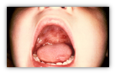 疱疹性咽颊炎图片嘴巴图片