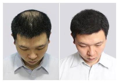 一种美容修复假发发卡的制作方法