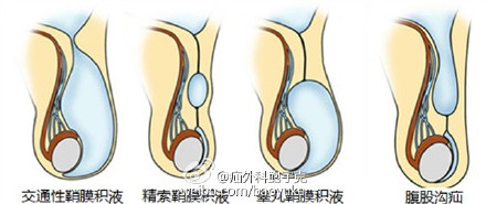 男寶寶的睪丸在生長過程中從肚子裡逐漸下降到陰囊底部,這時候一個