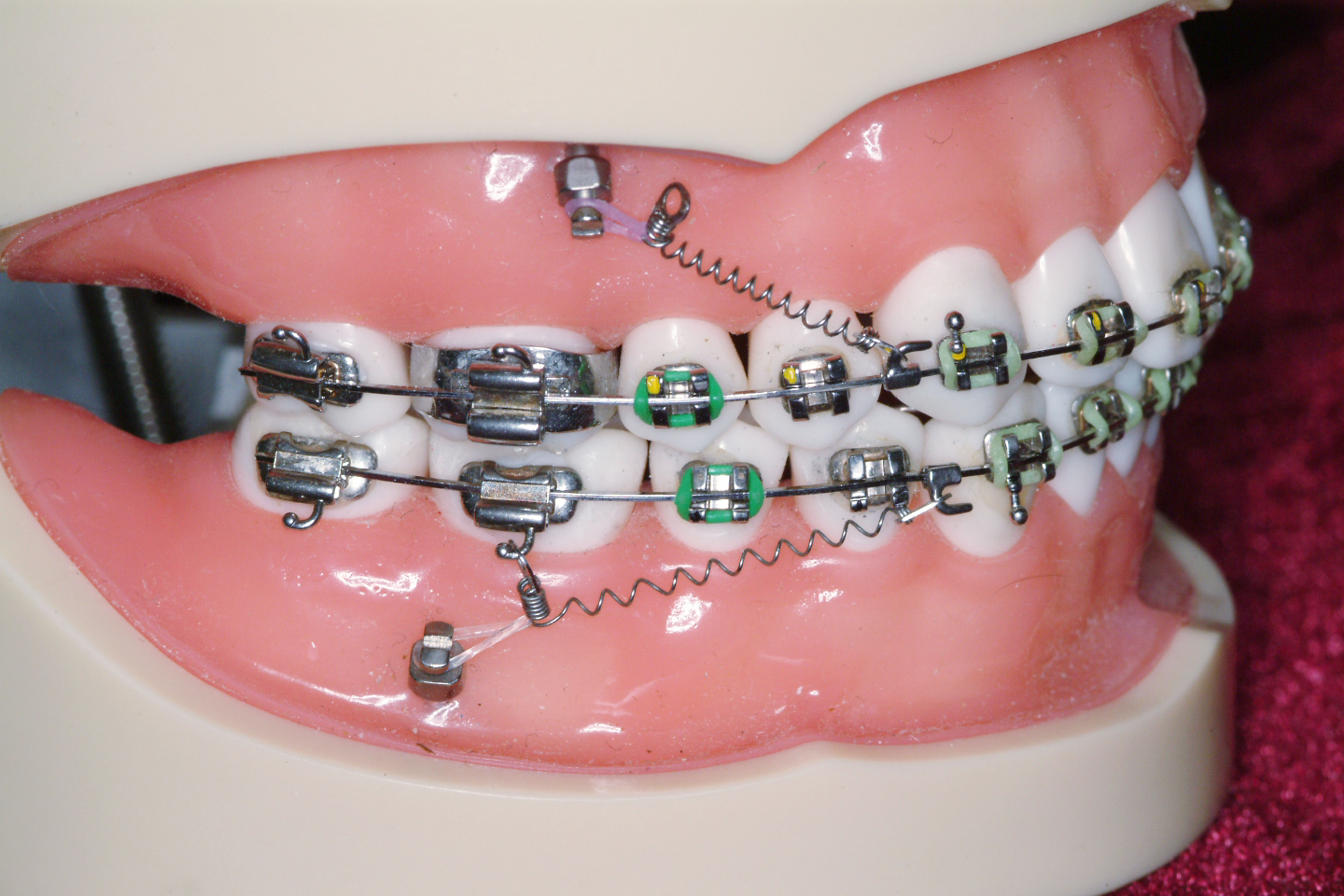 同样用于牙齿正畸,骨钉和附件有什么区别?