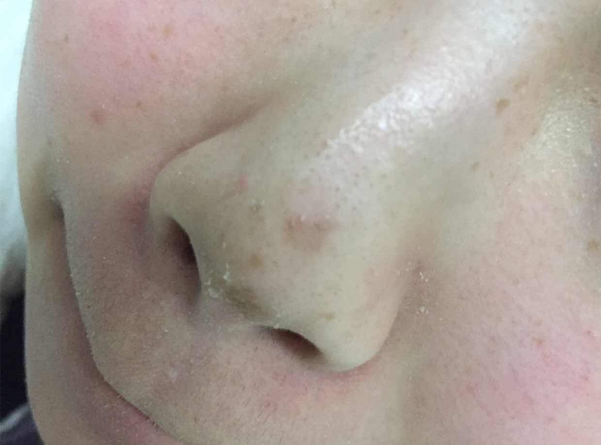 吴余乐(副主任医师):这个不是酒糟鼻,注意多抹点油脂类的霜剂就可以了