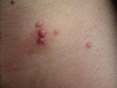 啪啪啪会得传染性软疣吗?-封新星主治医师-爱问医生