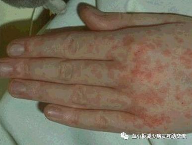 血小板减少会有哪些症状