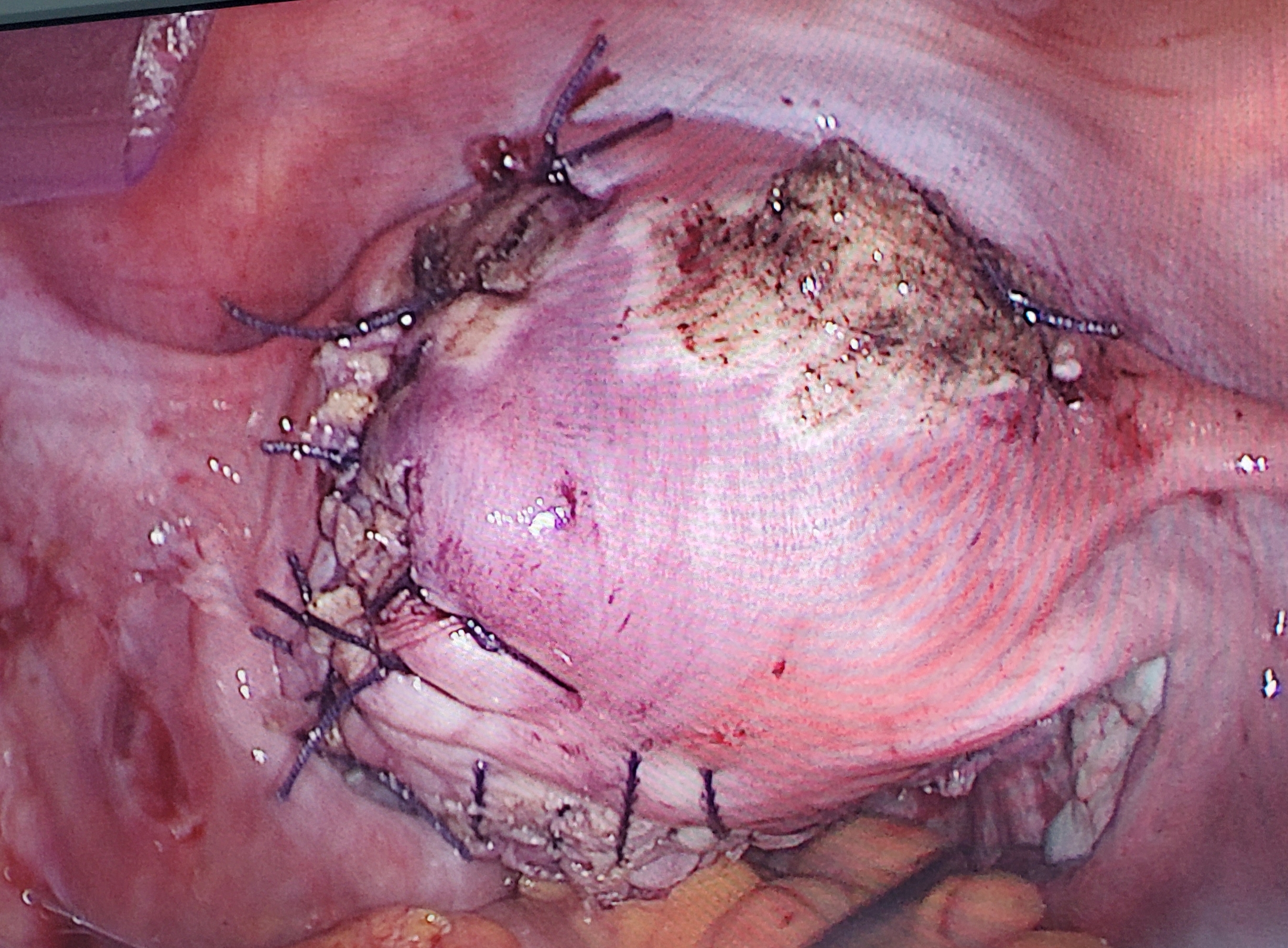 子宫肌瘤5公分图片图片