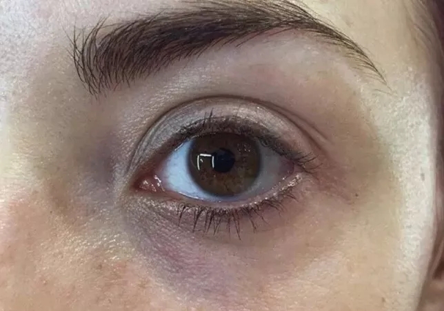 存在已久的黑眼圈还真有可能彻底消除