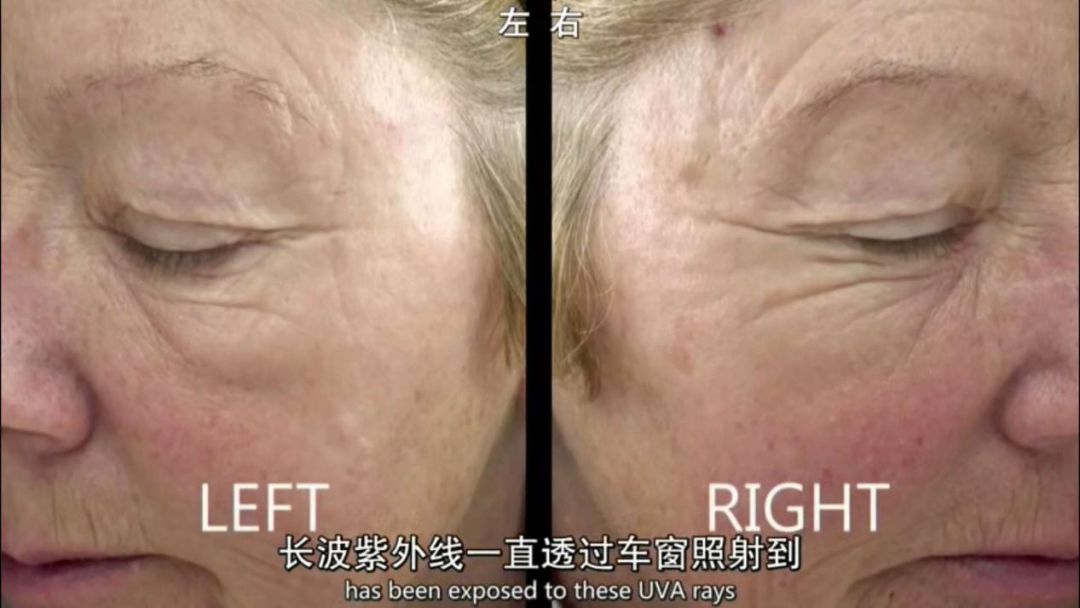 短波紫外线会晒伤皮肤,但长波紫外线才是真正造成皮肤老化的原因.