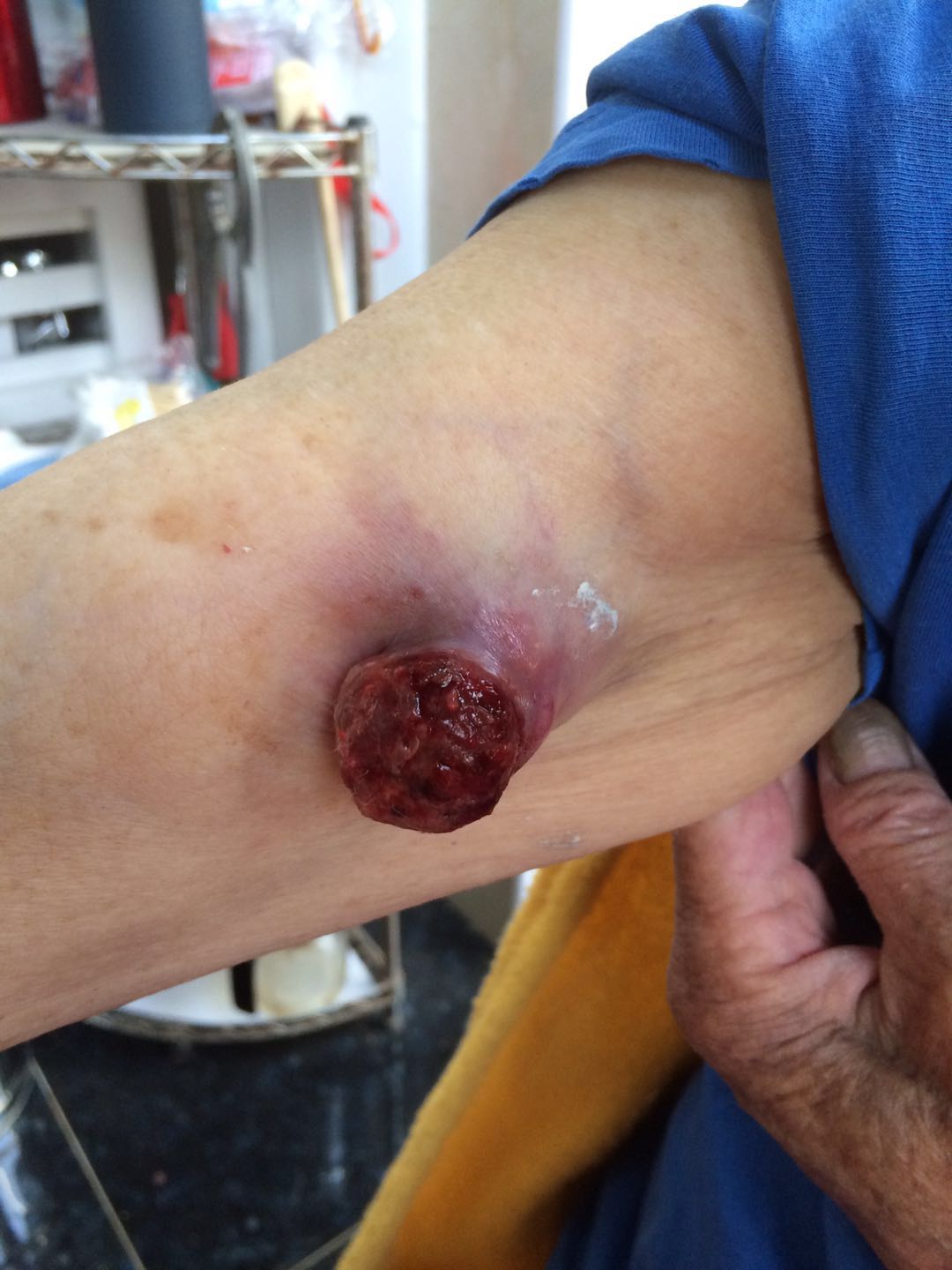 手臂恶性肿瘤初期图片图片