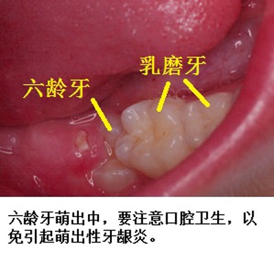 什么是六龄齿,六龄齿长出来还会换吗?