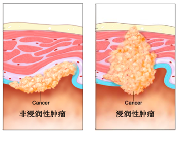 膀胱原位癌图片