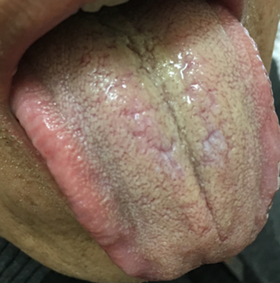 癌症舌象及中医分析吴中朝