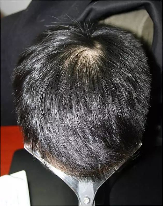 雄激素性秃发治疗方式及临床表现