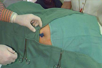 做过骨髓穿刺的患者,你知道这是怎么进行的吗?