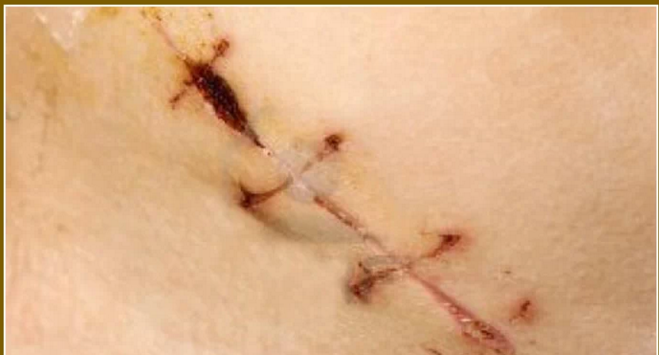 y型伤口缝合图片