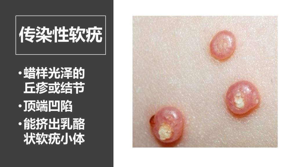 传染性软疣有那些危害