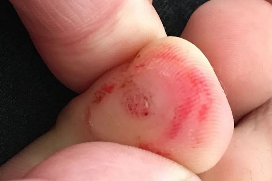 病毒疣(hpv)为啥会百变