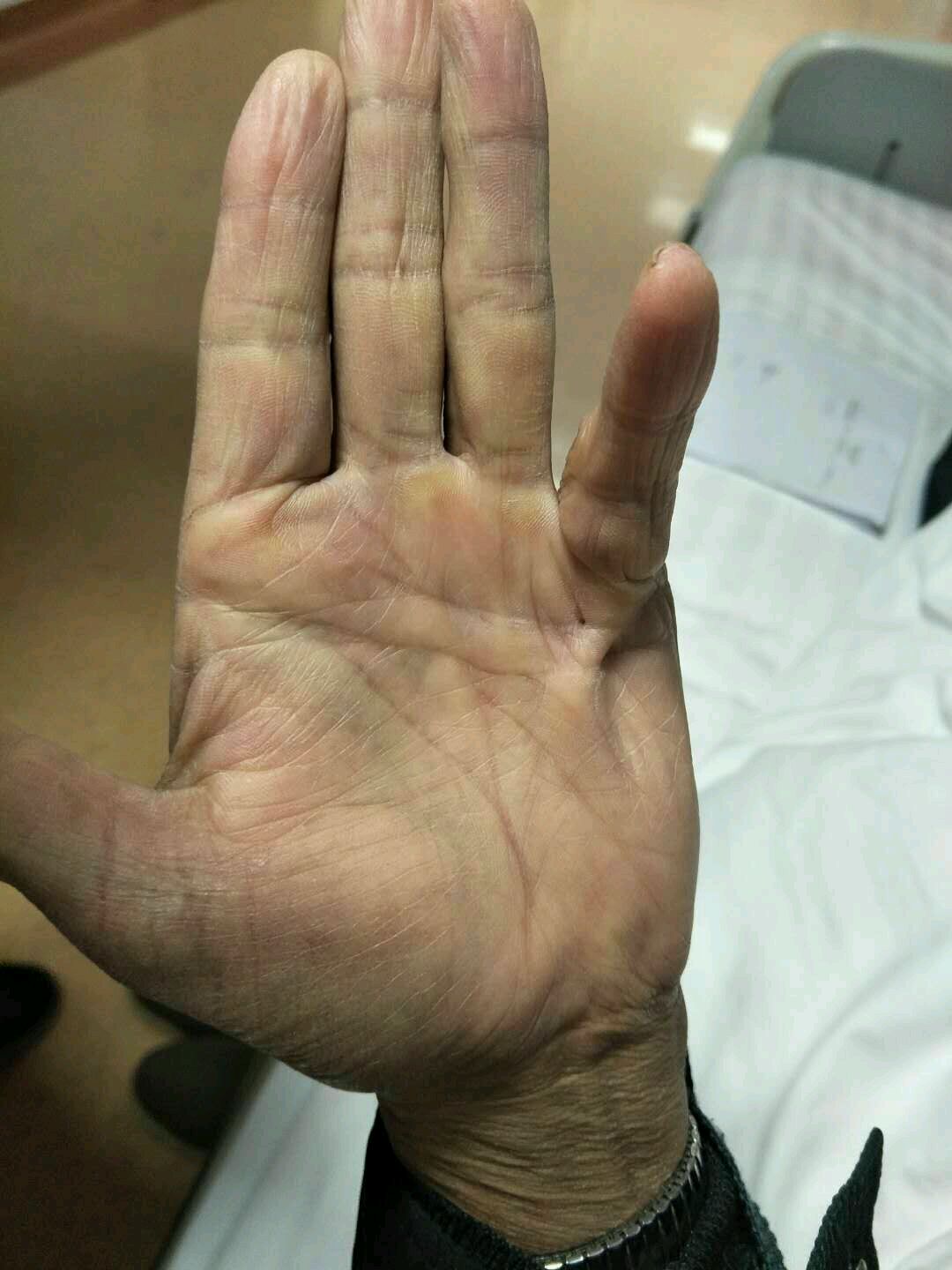 掌腱膜挛缩