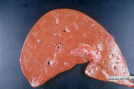 在慢性的基础上会爆发急性重型肝炎,如果持续发展下去,还有可能变成肝
