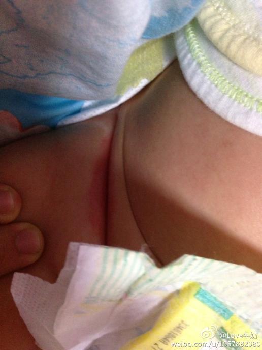 发现宝宝右侧大腿根部褶皱处出现这样一块红红的,是怎么了啊?