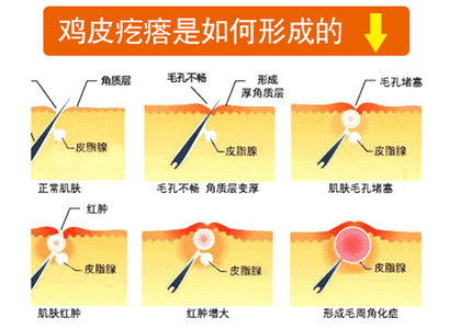 胸前瘙痒鸡皮肤原因(皮肤出现鸡皮肤并且还痒)