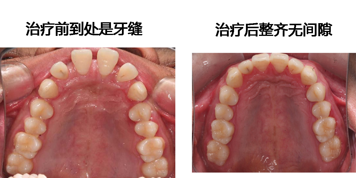 牙间隙总.jpg