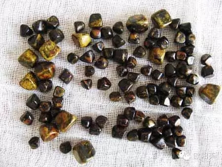 色素结石:由胆红素质所形成,常见于有溶血疾病的病人或有细菌,寄生虫