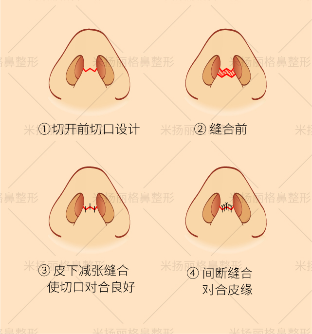 隆鼻手术切口如何选择?