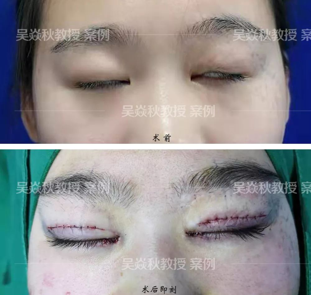 (上图案例:求美者之前出过一次车祸,导致上睑皮肤没有了,后期做过植皮