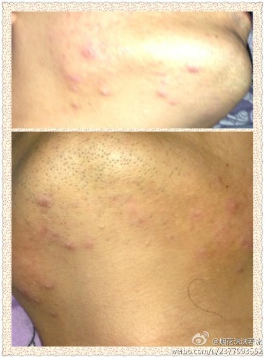 30岁男性,下巴老是长类似的小疙瘩