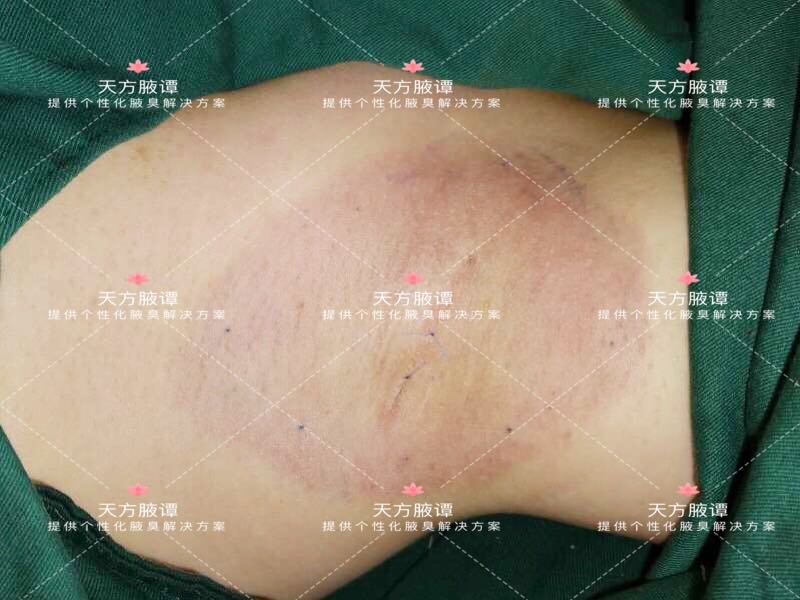 腋下皮膚過敏時可以做腋臭手術嗎?# 【一千零一腋】之609