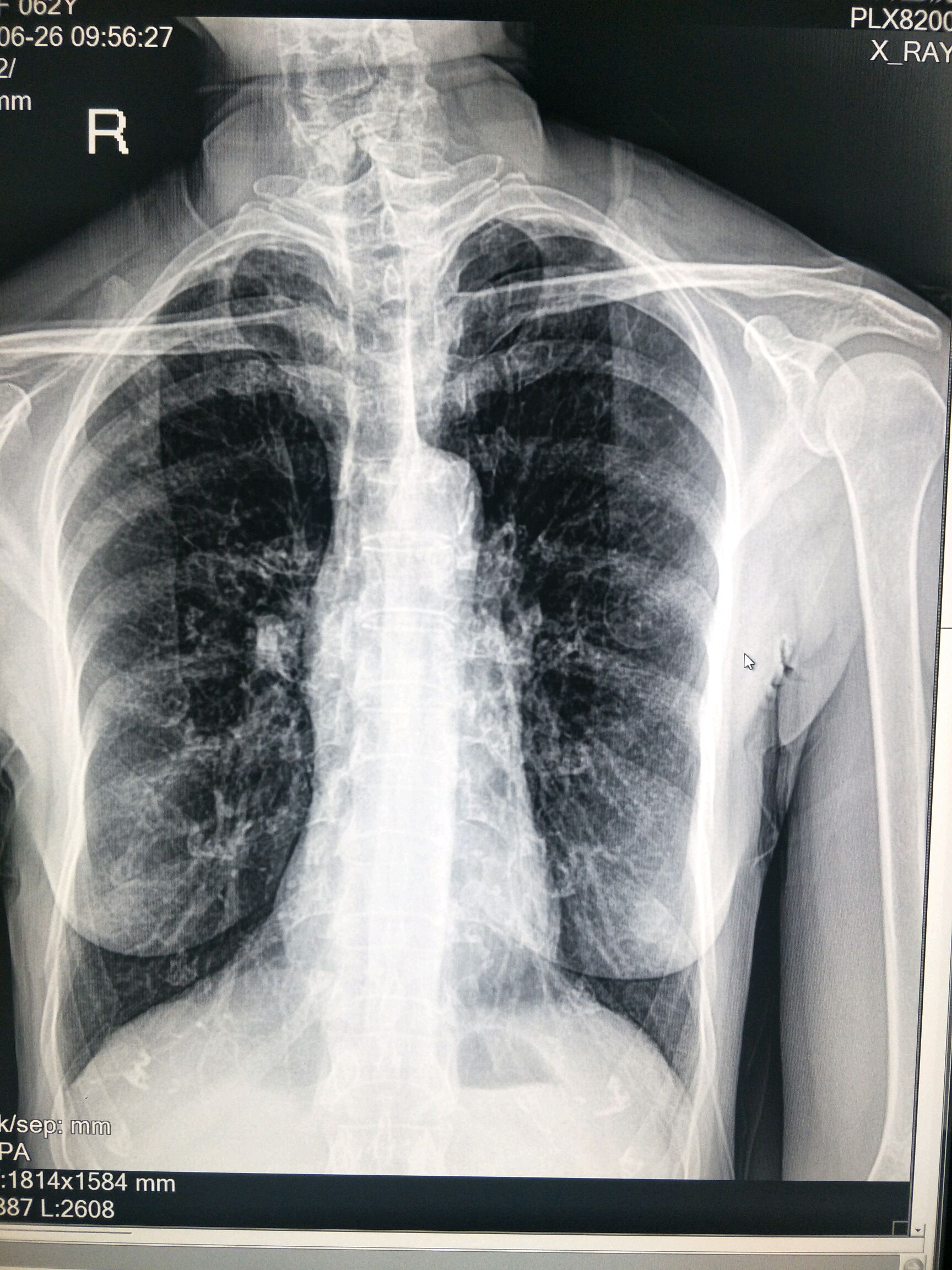 二期尘肺图片图片
