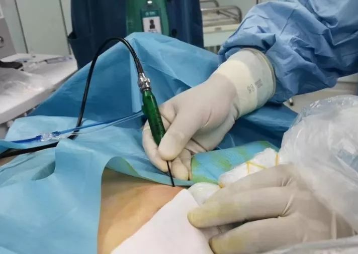乳腺良性结节微波消融 vs 激光消融,到底哪种好?