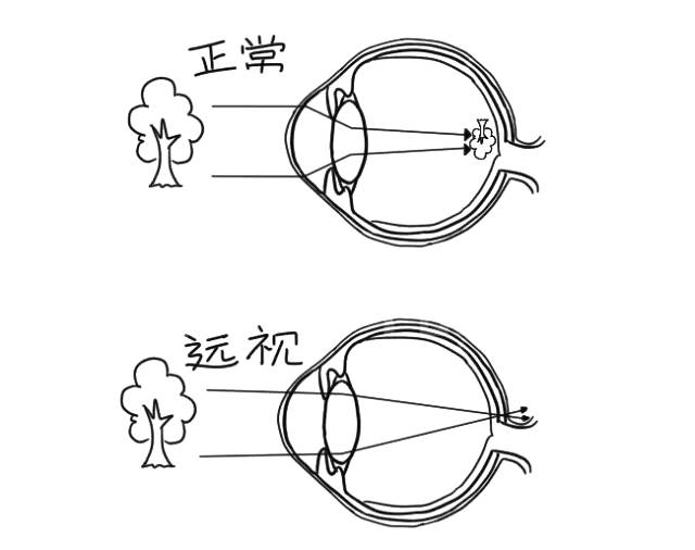 图解1分钟教你快速区分近视远视散光