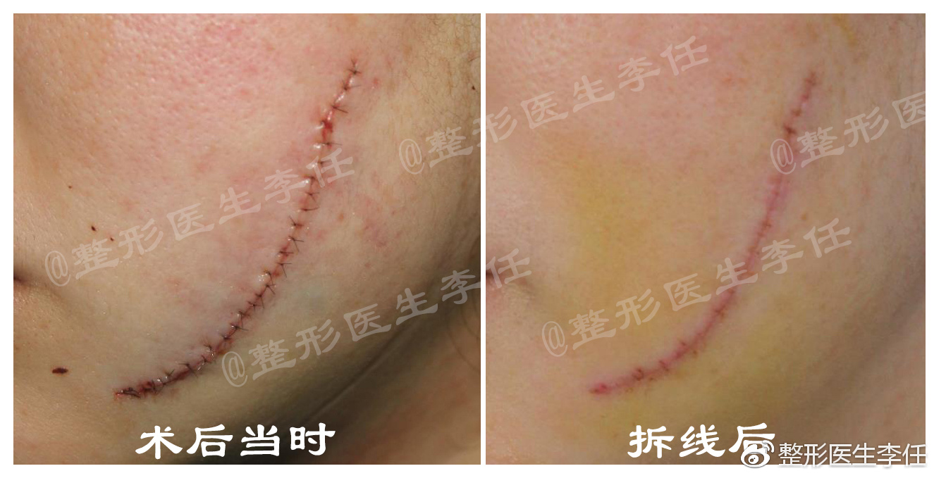 瘢痕疤痕能完全消除吗