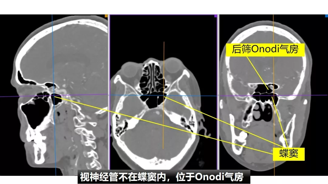赵天智副教授前床突磨除与脑脊液漏处理中鼻道经筛入路