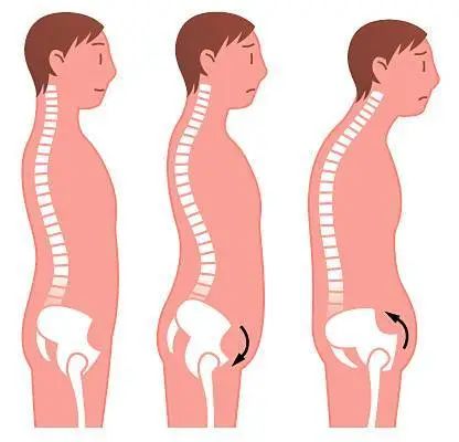 骨盆前傾如何糾正!