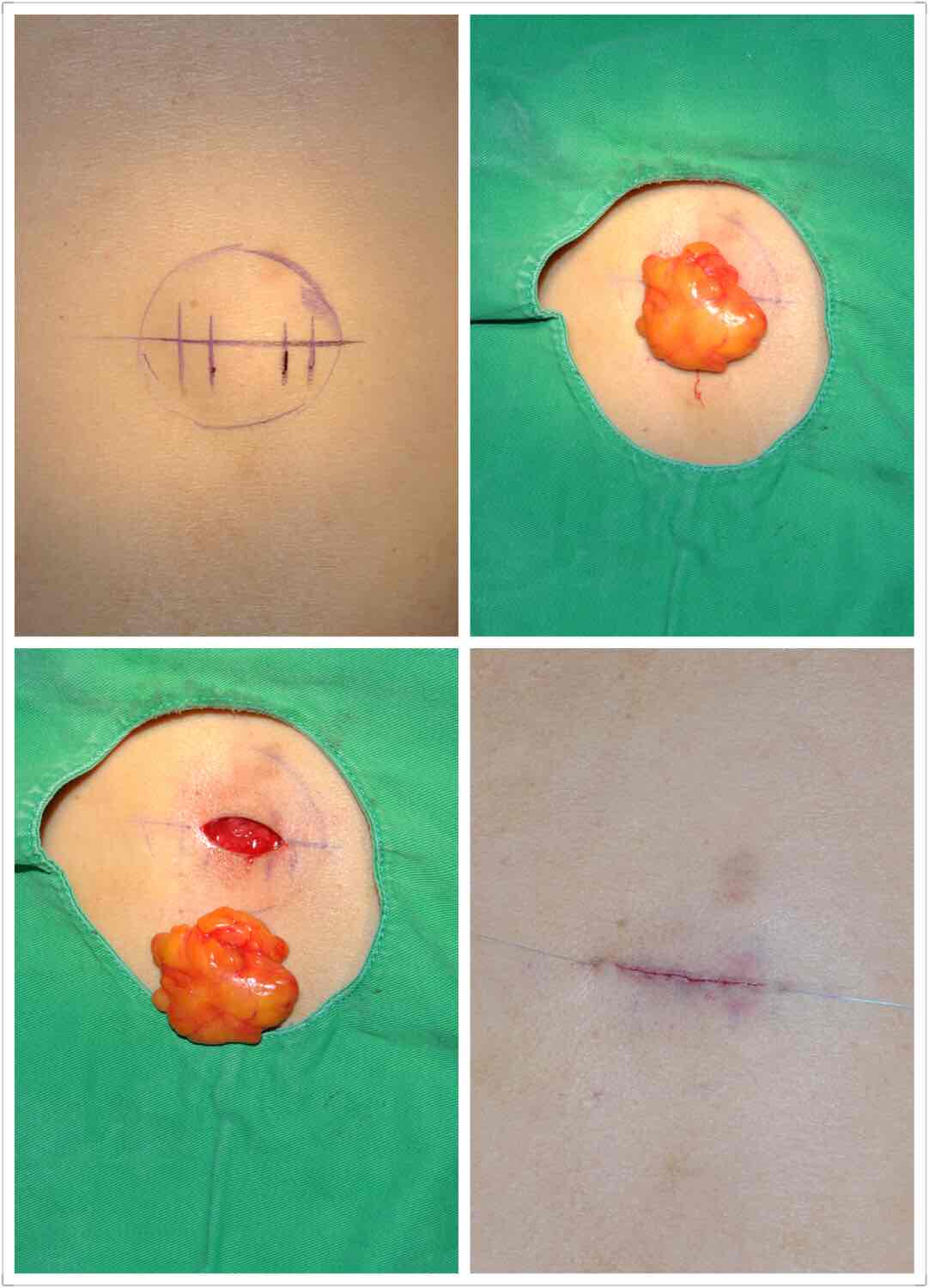 脂肪瘤刀口恢复图片图片