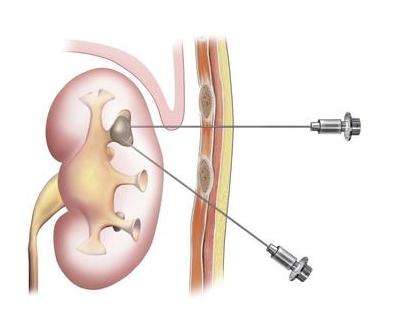 论肾穿刺的重要性,紫癜性肾炎患者必看