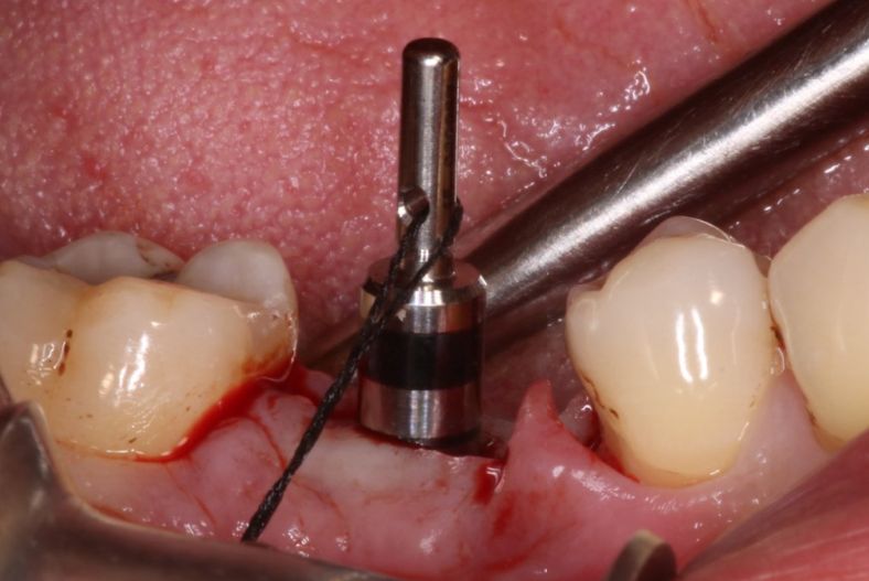 一例下颌后牙种植修复案例