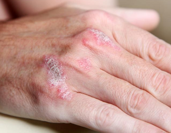 牛皮癣又称白疕,牛皮癣,松皮癣,分为:其实牛皮癣并不是癣,很多人以为