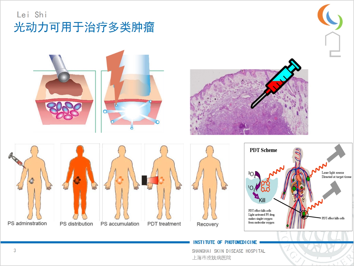 新型光動力治療腫瘤無需手術美容效果好你瞭解嗎