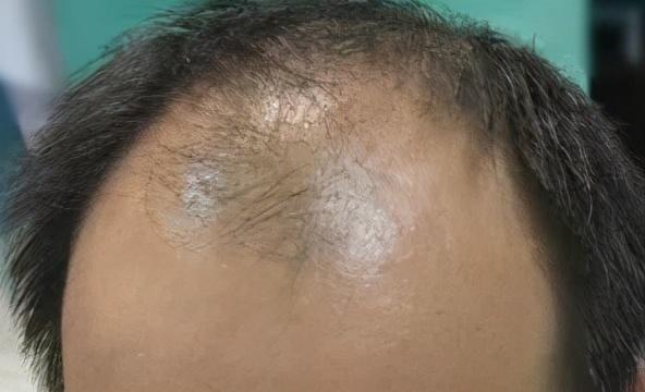 雄激素脱发如何改善?雄性脱发的三种状态应如何改善?