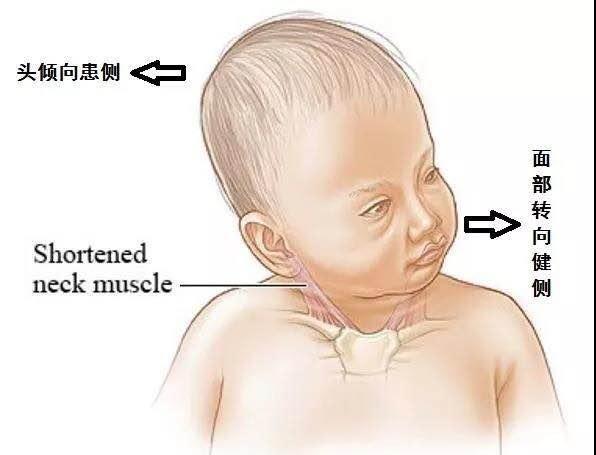 小孩歪脖子确诊了先天性肌斜颈要怎么办